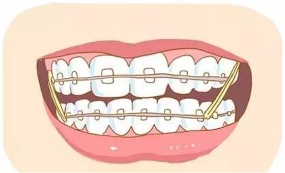 长沙牙齿矫正