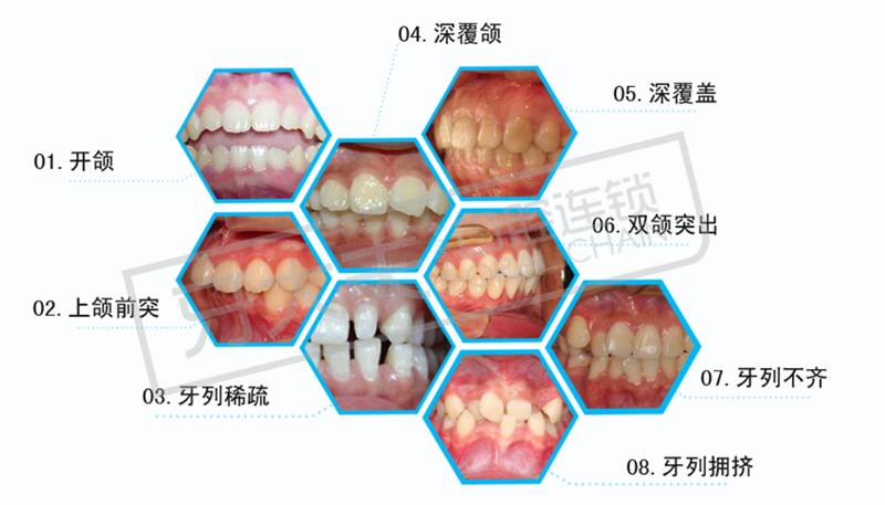 牙齿矫正类型_副本.png