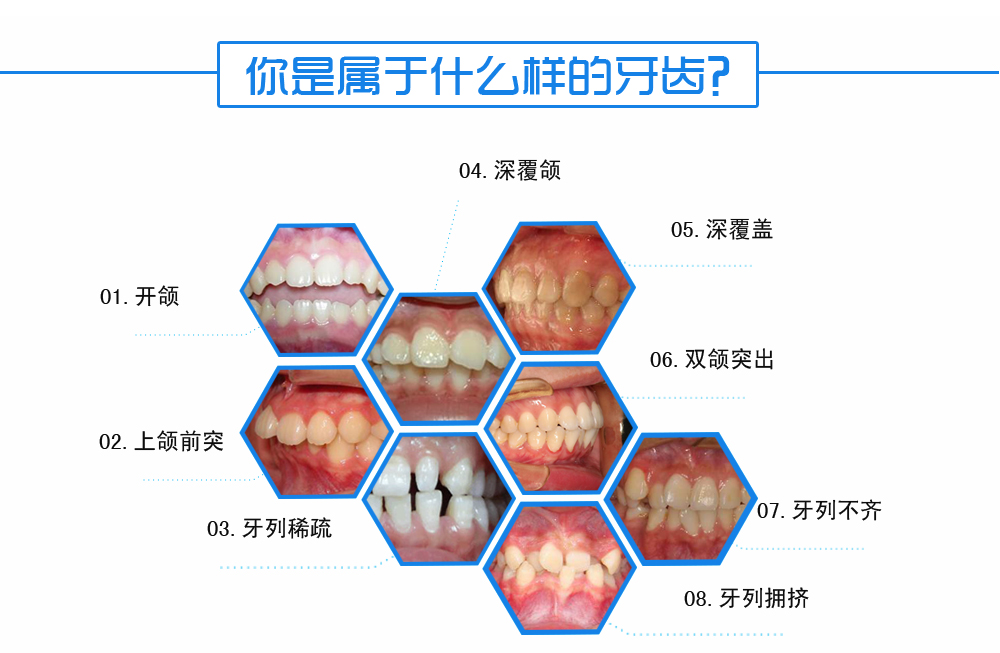 活动翼矫正总_03.png