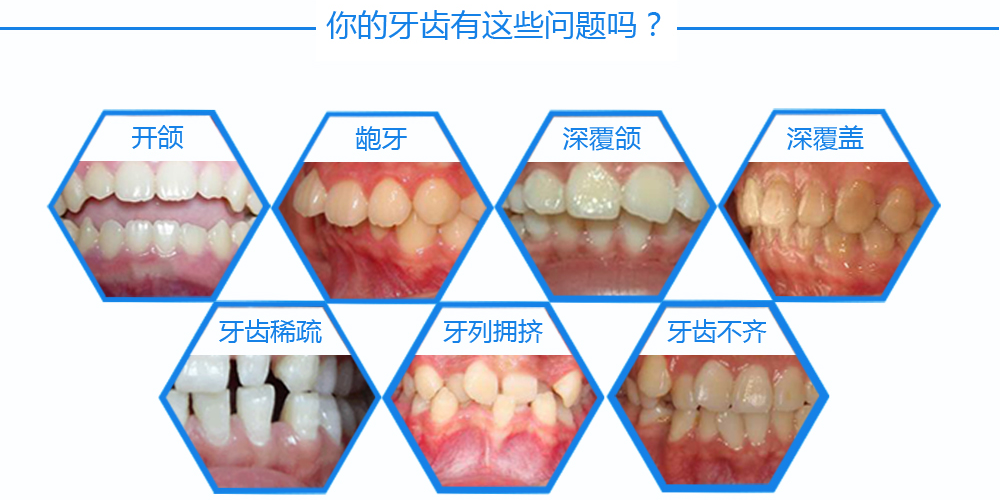 3M矫治器_02.png