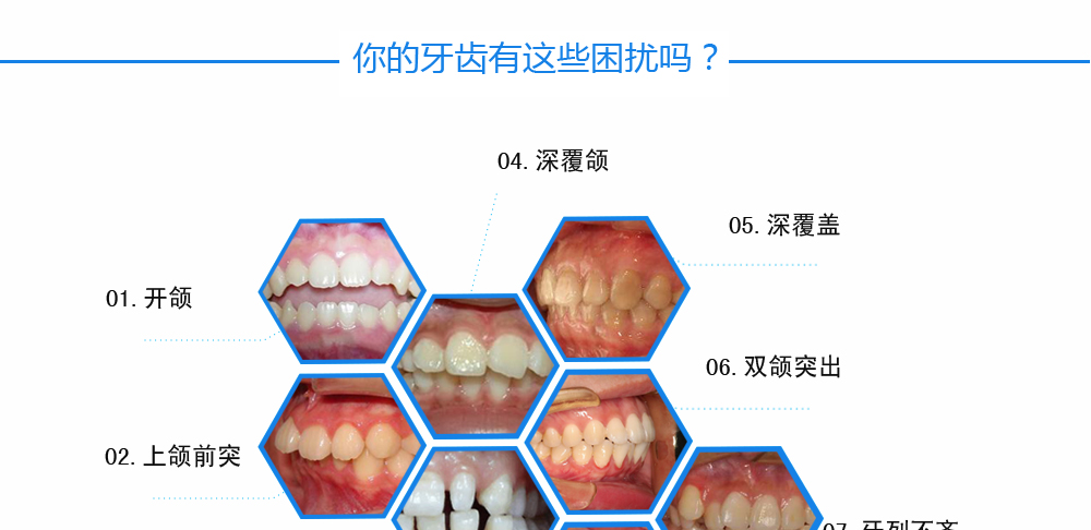 自锁托槽矫正_03.png