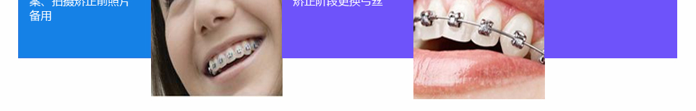 自锁托槽矫正_07.png