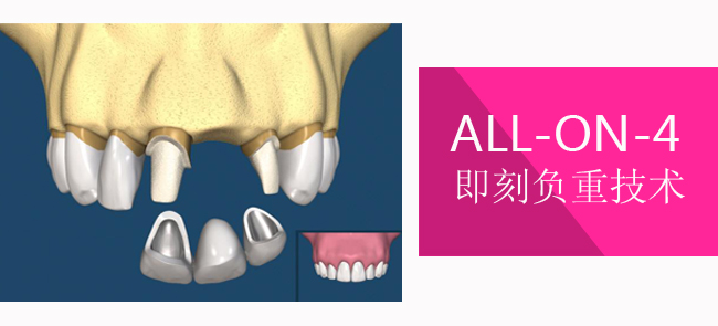 什么是即刻种植2.jpg