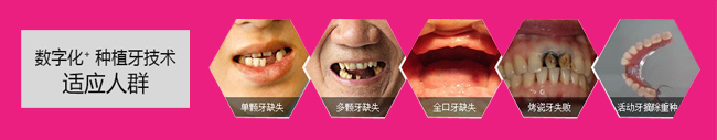 德伦口腔数字化 种植牙技术2.jpg
