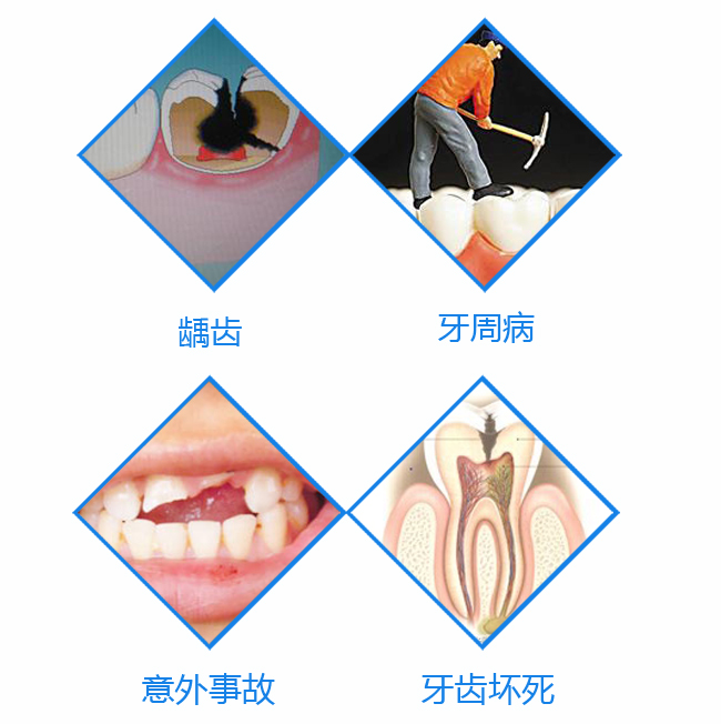 缺牙患者是青年2.jpg