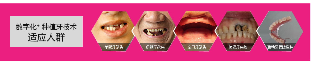 数字化种植牙_02.png