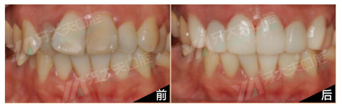 上牙6颗形态难看全瓷修复一例