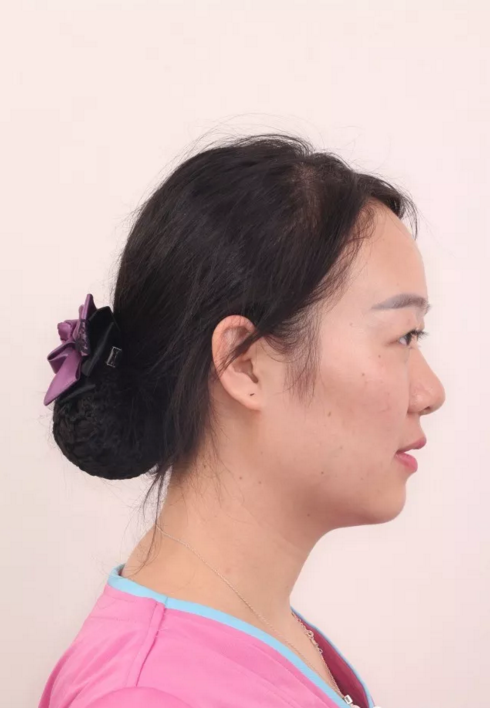 牙套日记侧面照 牙套日记侧面照
