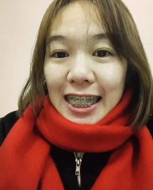 牙套日记牙套照片 牙套日记牙套照片