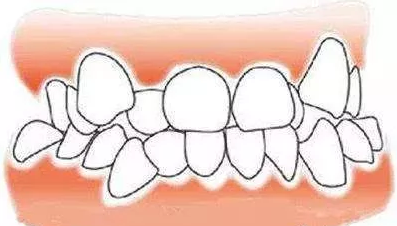长沙牙齿拥挤