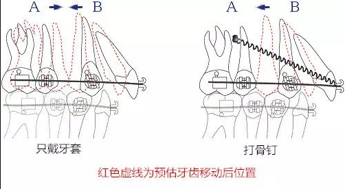 矫正效果