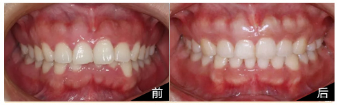 牙套日记：深覆合少女的牙套历程